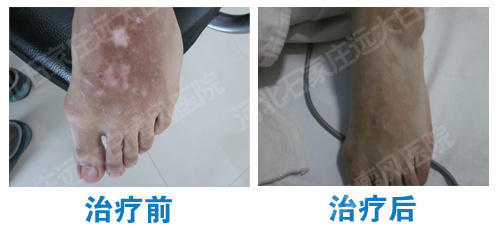 白癜风的白斑区皮肤为什么会发痒