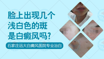 WOOD灯检查白癜风的结果分析