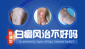 `Wood灯检查白癜风有危害吗`