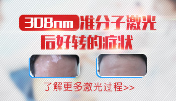伍德灯在早期白癜风诊断中的准确性探析