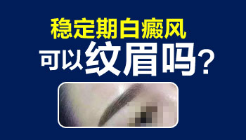 用伍德灯照不排除有白癜风的情况详解