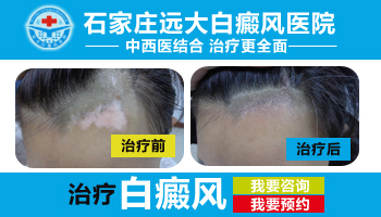 伍德灯在初期白癜风诊断中的应用与准确性探讨