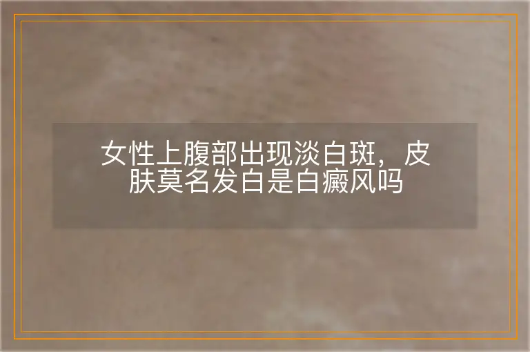 女性上腹部出现淡白斑,皮肤莫名发白是白癜风吗
