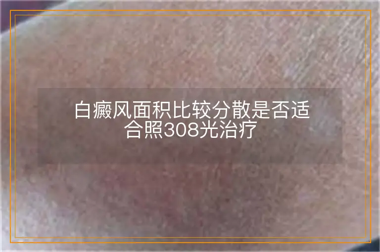 白癜风面积比较分散是否适合照308光治疗