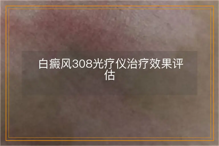 白癜风308光疗仪治疗效果评估