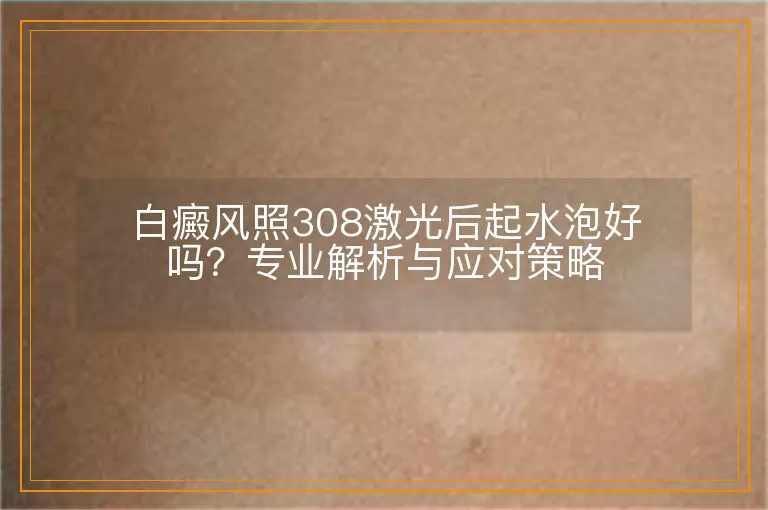 白癜风照308激光后起水泡好吗？专业解析与应对策略