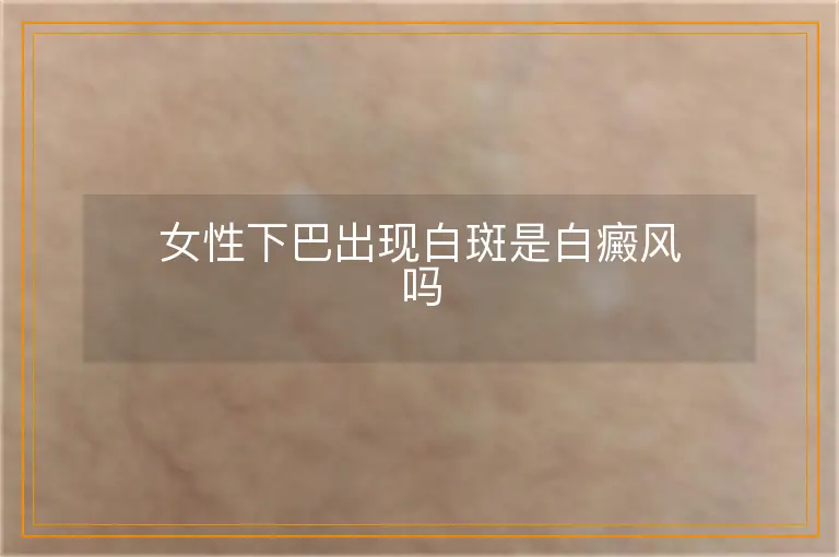 女性下巴出现白斑是白癜风吗