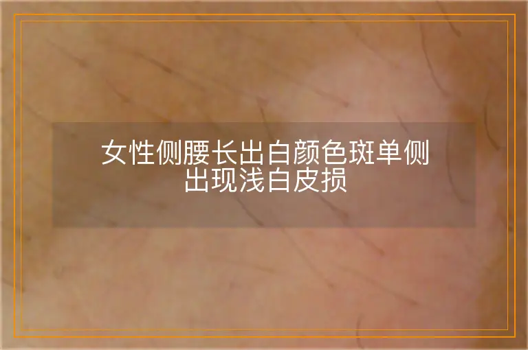 女性侧腰长出白颜色斑单侧出现浅白皮损