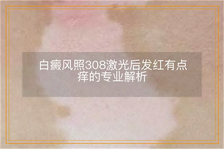 白癜风照308激光后发红有点痒的专业解析