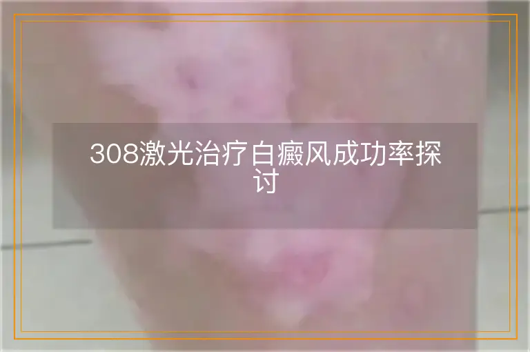 308激光治疗白癜风成功率探讨