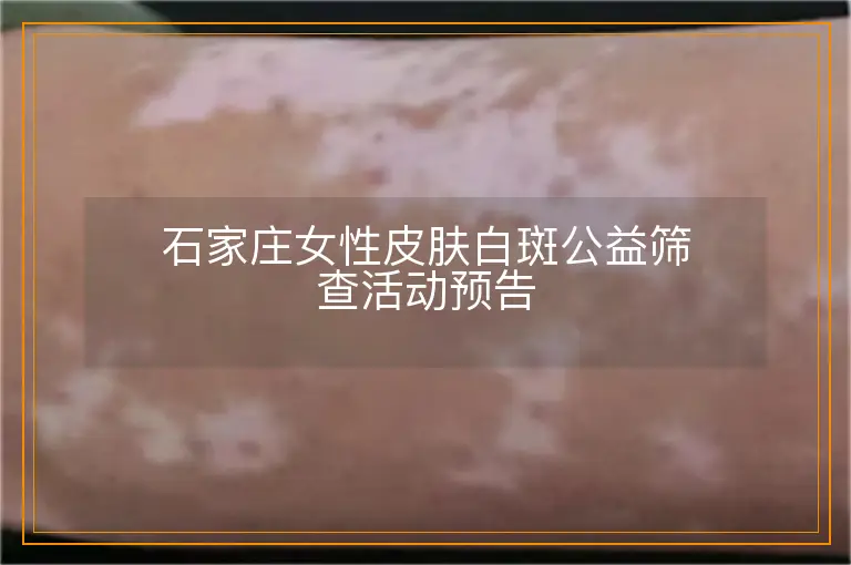 石家庄女性皮肤白斑公益筛查活动预告