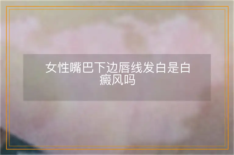 女性嘴巴下边唇线发白是白癜风吗