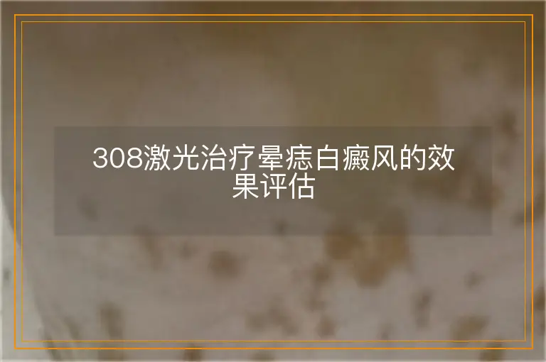 308激光治疗晕痣白癜风的效果评估