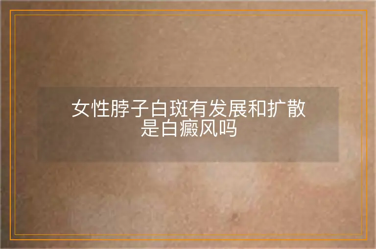 女性脖子白斑有发展和扩散是白癜风吗