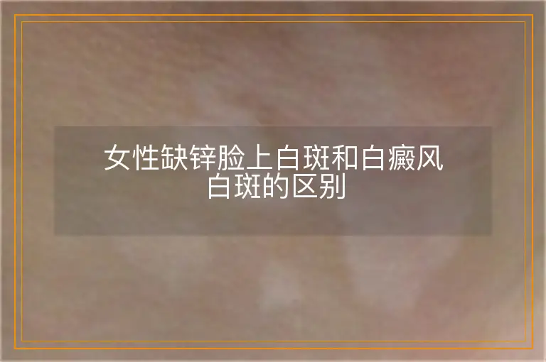 女性缺锌脸上白斑和白癜风白斑的区别