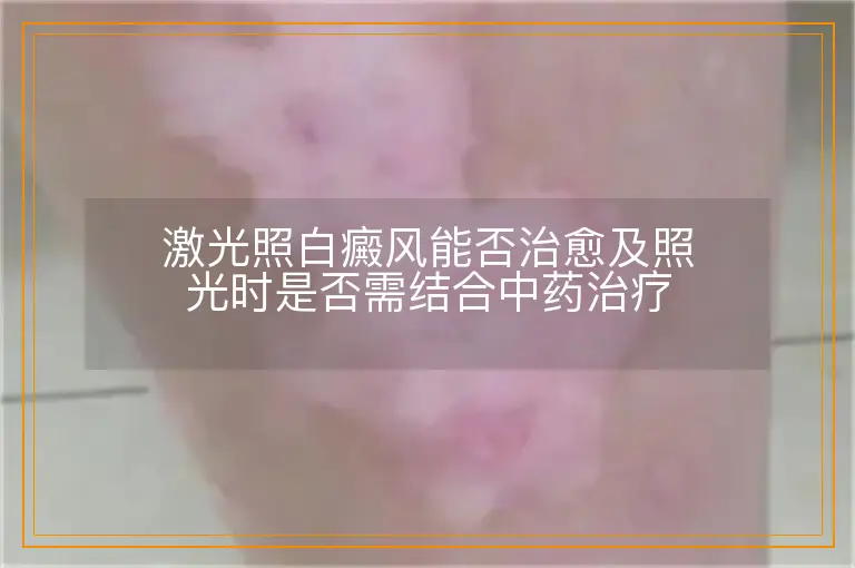 激光照白癜风能否治愈及照光时是否需结合中药治疗