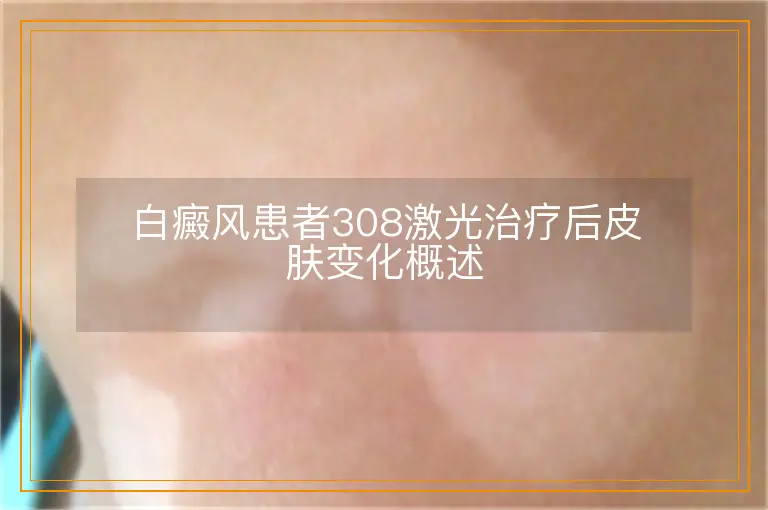 白癜风患者308激光治疗后皮肤变化概述