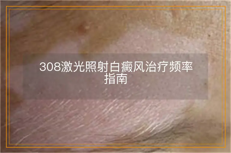 308激光照射白癜风治疗频率指南