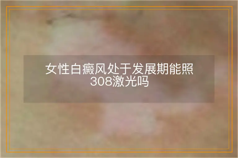 女性白癜风处于发展期能照308激光吗