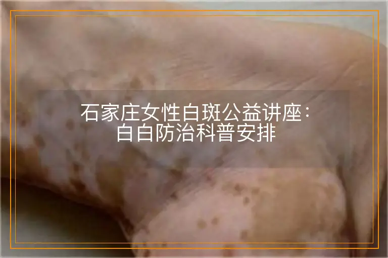 石家庄女性白斑公益讲座:白白防治科普安排