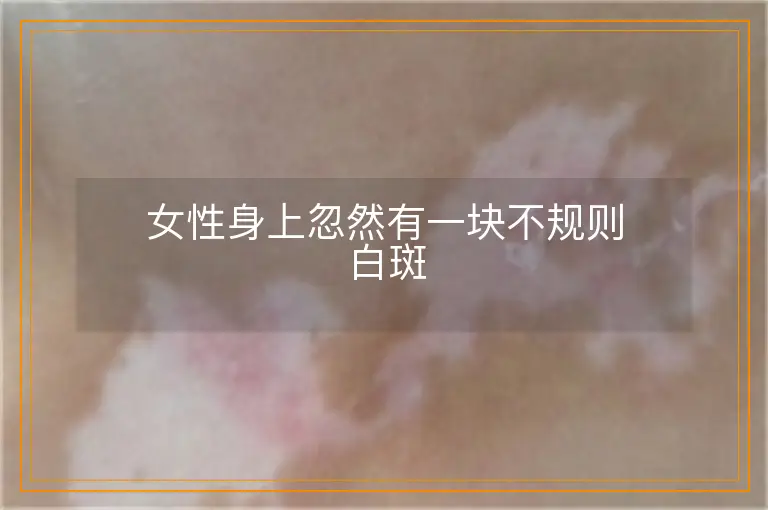 女性身上忽然有一块不规则白斑