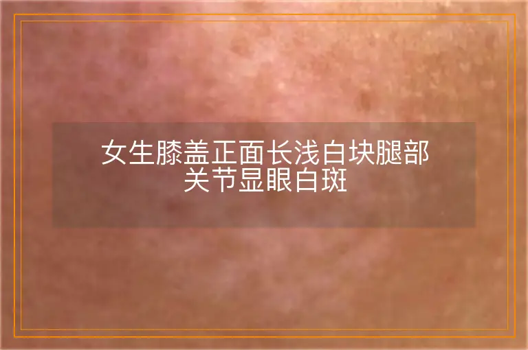 女生膝盖正面长浅白块腿部关节显眼白斑