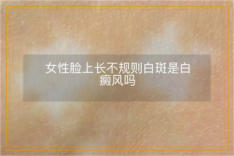 女性脸上长不规则白斑是白癜风吗