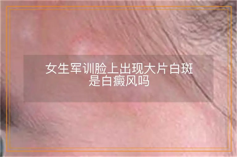 女生军训脸上出现大片白斑是白癜风吗