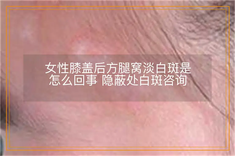 女性膝盖后方腿窝淡白斑是怎么回事 隐蔽处白斑咨询