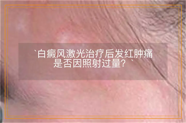 白癜风激光治疗后发红肿痛是否因照射过量？