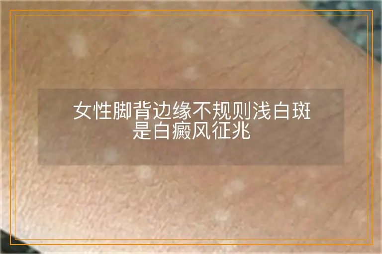 女性脚背边缘不规则浅白斑是白癜风征兆