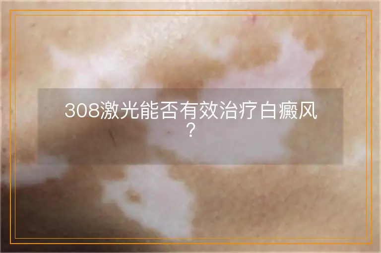 308激光能否有效治疗白癜风？