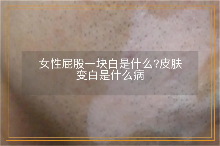 女性屁股一块白是什么?皮肤变白是什么病