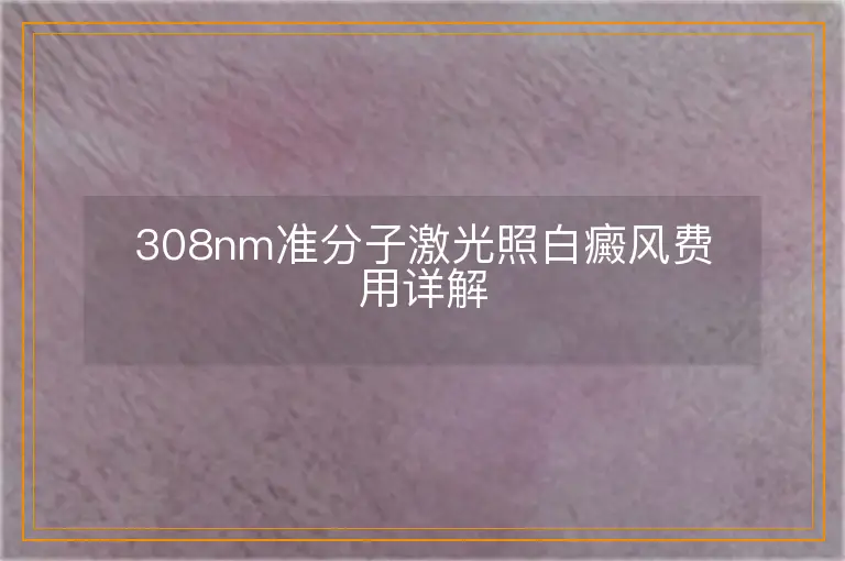 308nm准分子激光照白癜风费用详解