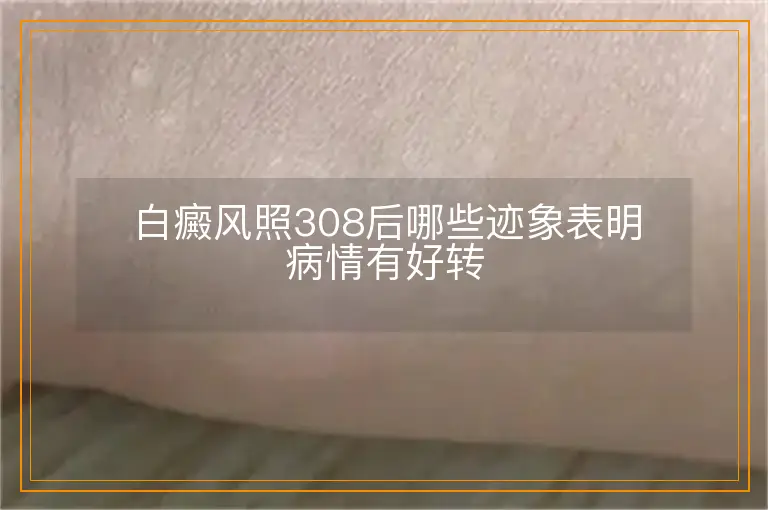 白癜风照308后哪些迹象表明病情有好转