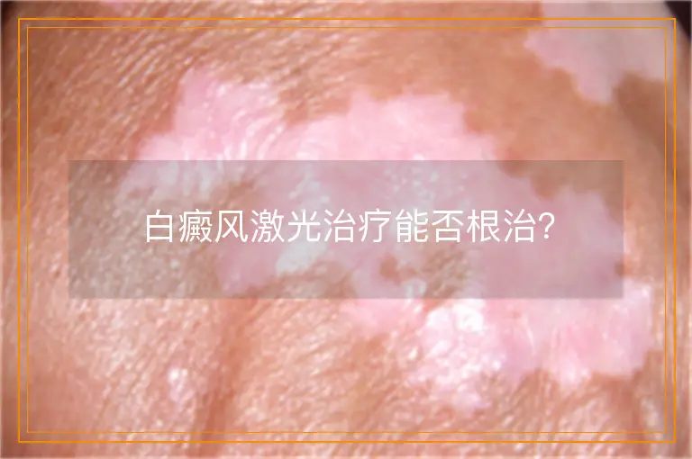 白癜风激光治疗能否根治?