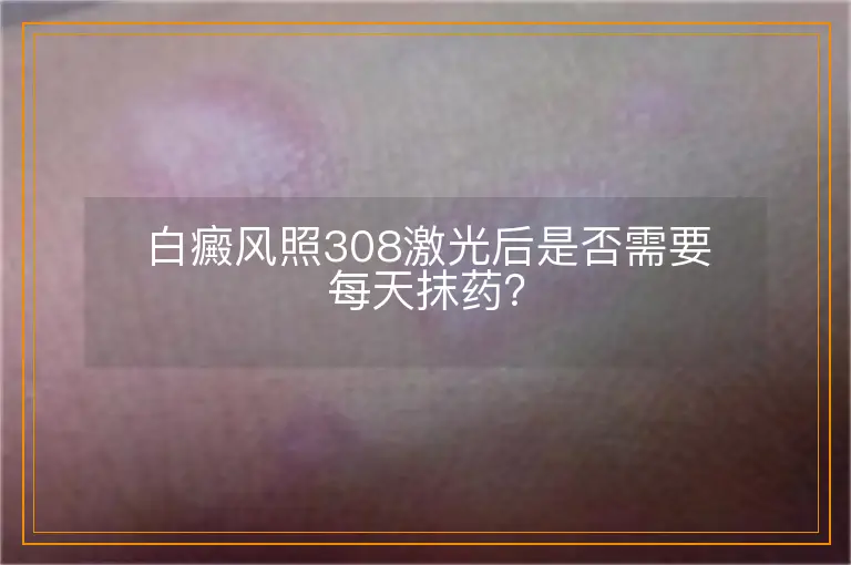白癜风照308激光后是否需要每天抹药？