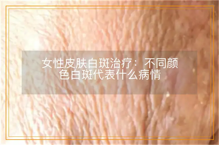 女性皮肤白斑治疗:不同颜色白斑代表什么病情