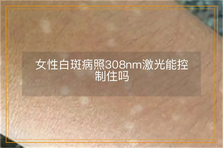 女性白斑病照308nm激光能控制住吗
