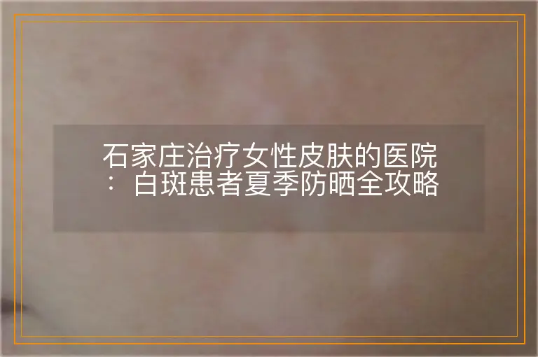 石家庄治疗女性皮肤的医院:白斑患者夏季防晒全攻略