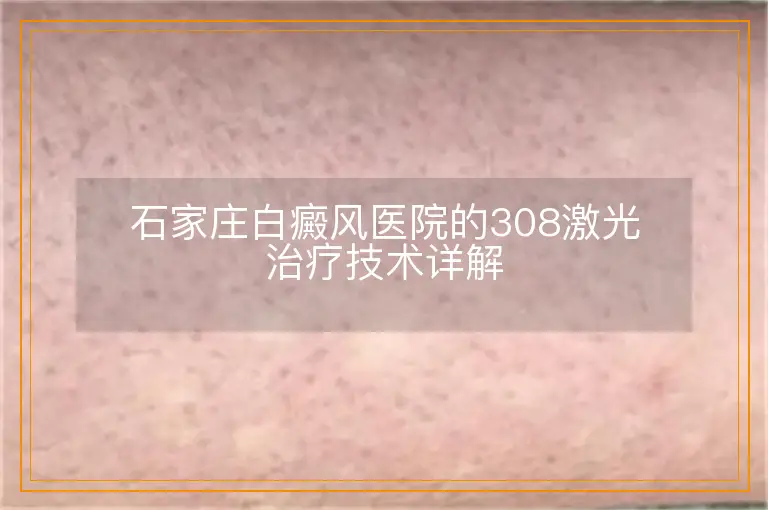 石家庄白癜风医院的308激光治疗技术详解