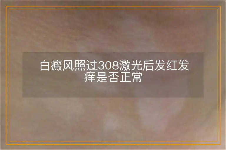 白癜风照过308激光后发红发痒是否正常