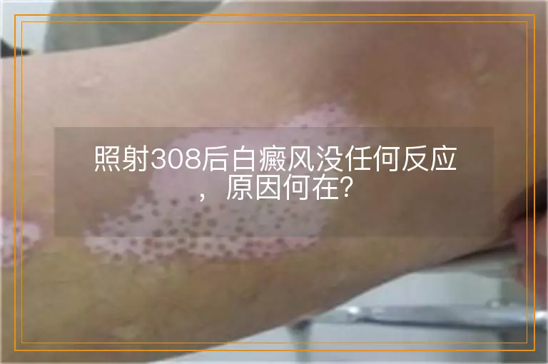 照射308后白癜风没任何反应，原因何在？