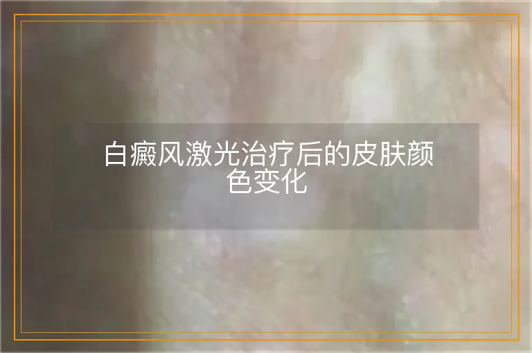 白癜风激光治疗后的皮肤颜色变化