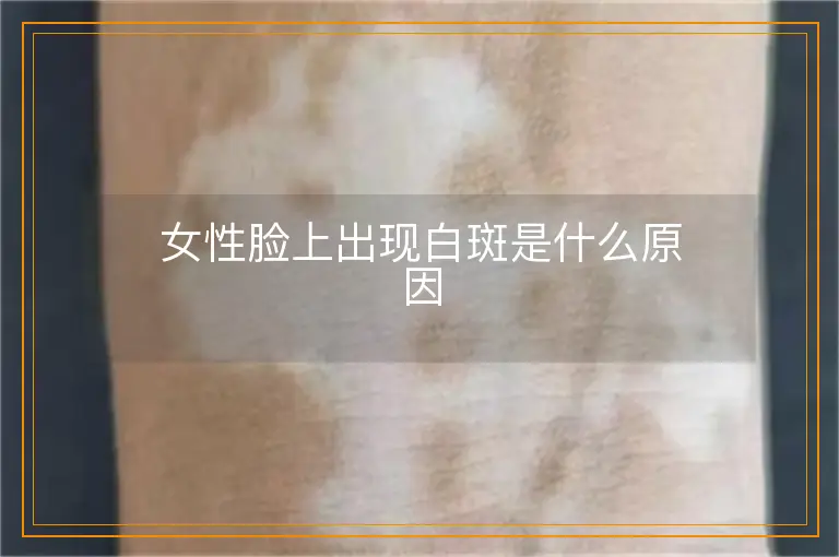 女性脸上出现白斑是什么原因