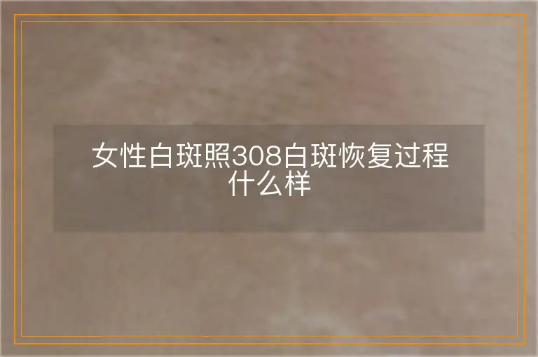 女性白斑照308白斑恢复过程什么样