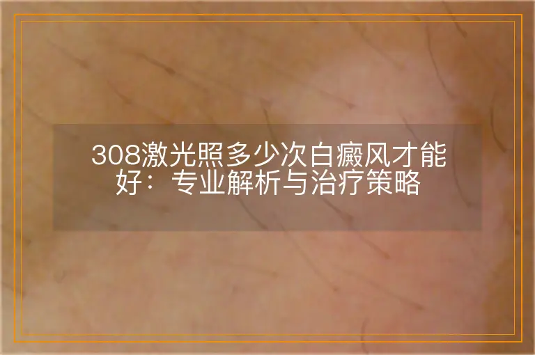 308激光照多少次白癜风才能好：专业解析与治疗策略