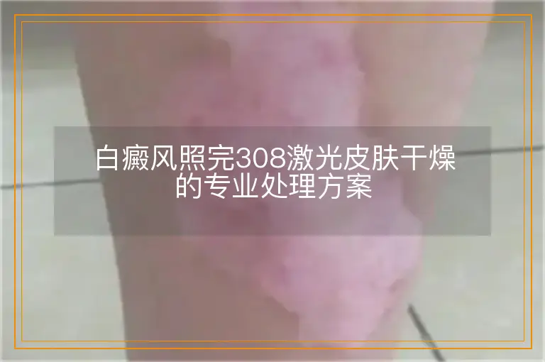 白癜风照完308激光皮肤干燥的专业处理方案