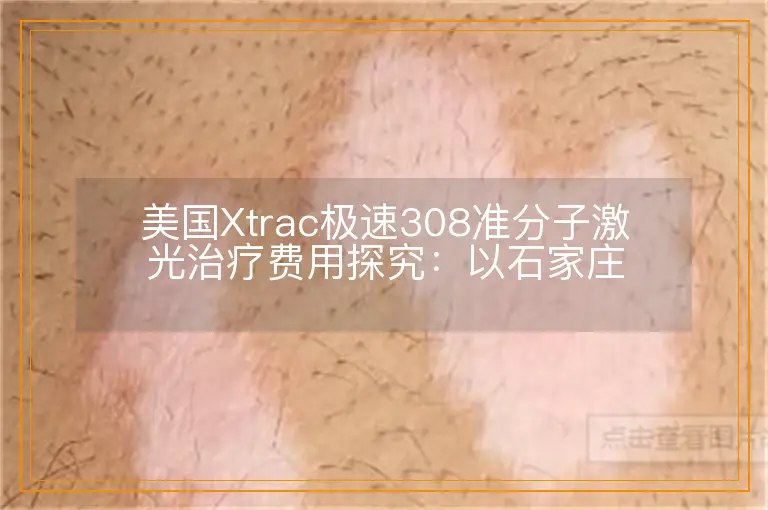 美国Xtrac极速308准分子激光治疗费用探究：以石家庄地区为例