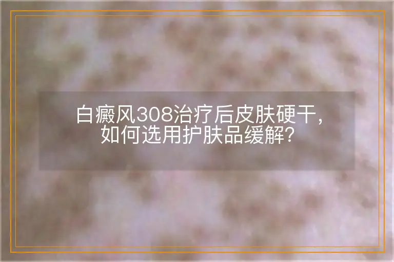 白癜风308治疗后皮肤硬干，如何选用护肤品缓解？
